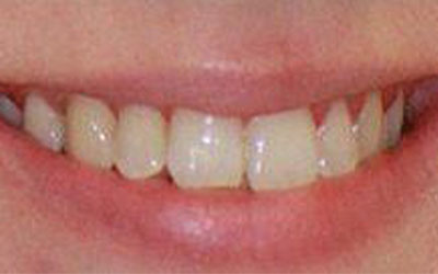 crooked teeth after treatment