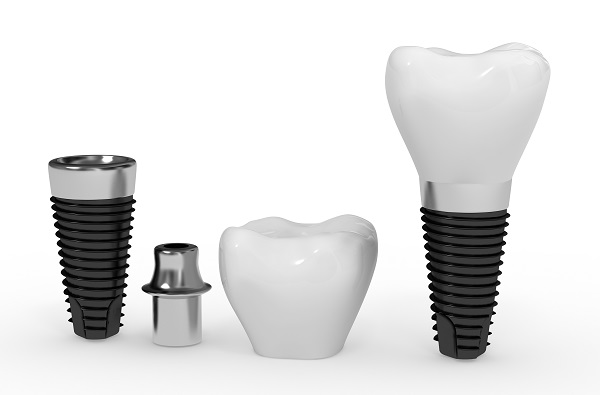Dental Implants Bloomington, MN